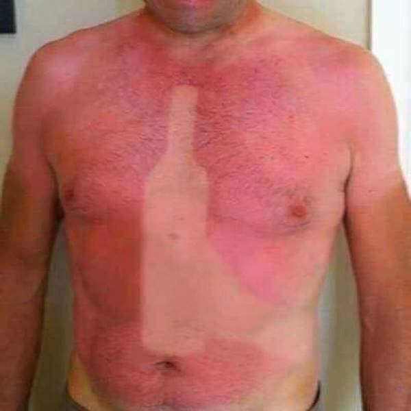 Drunk sunburn.