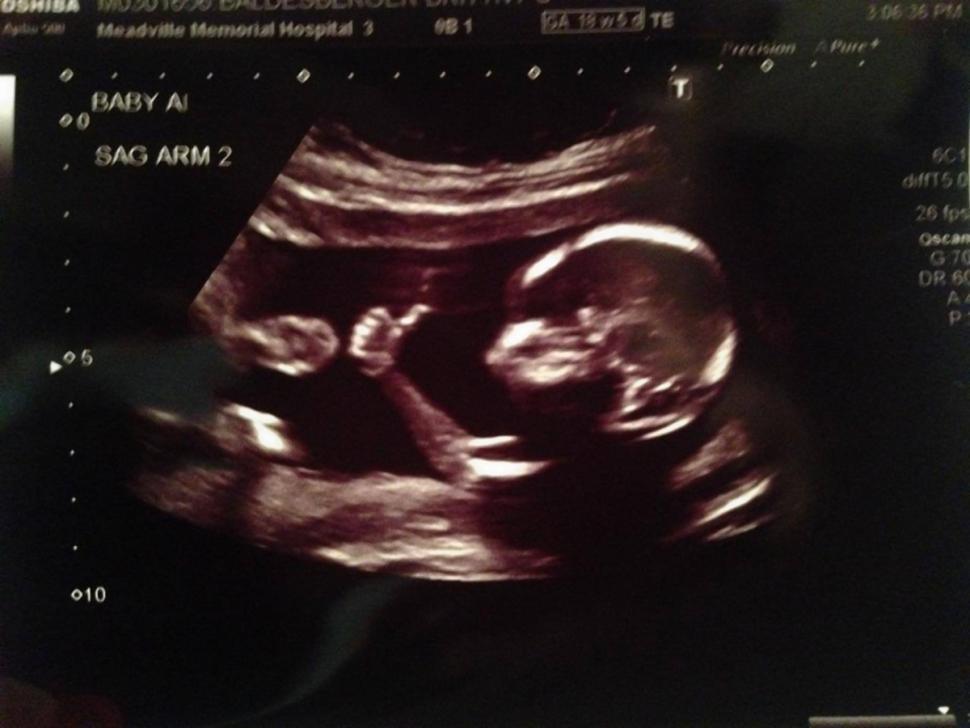 Baby still in the womb is seen giving a thumbs up when an ultrasound is performed.