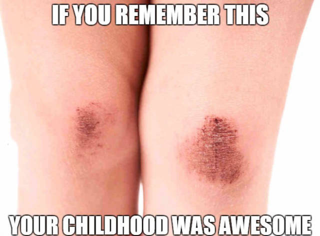 Skinned knees = Awesome childhood